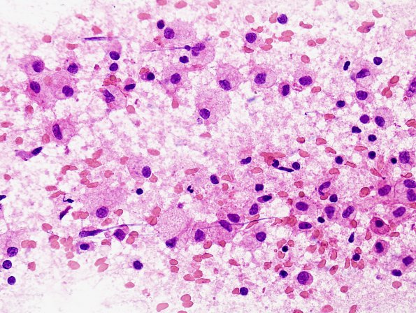 1C1 Multiple Sclerosis, Tumefactive MS (Case 1) 40X intraoperative sm 1 (2)