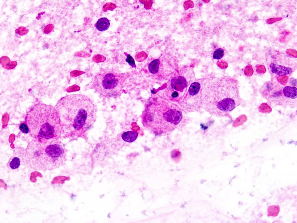 1C2 Inflammatory Demyelination (Case 1) FS 2