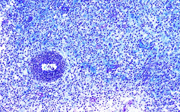 1E1 Inflammatory Demyelination (Case 1) LFB-PAS 3