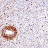 1G2 Inflammatory Demyelination (Case 1) CD3 match A