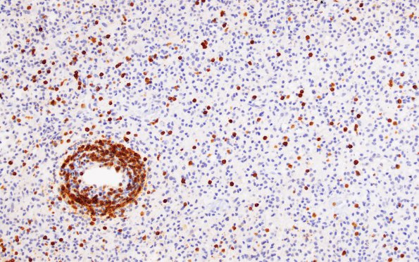 1G2 Inflammatory Demyelination (Case 1) CD3 match A