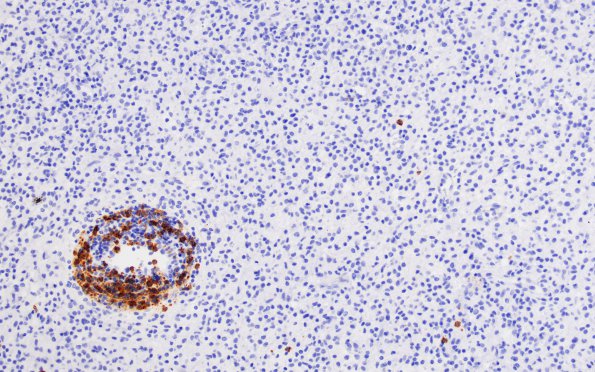 1G3 Inflammatory Demyelination (Case 1) CD20 match A