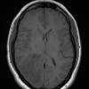 2A2 MS, tumefactive (Case 2) T1 no contrast (PreBx) - Copy