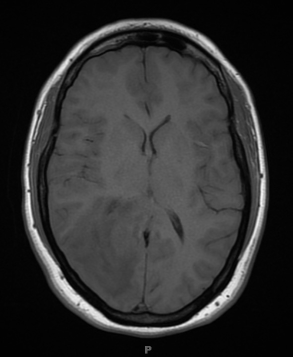 2A2 MS, tumefactive (Case 2) T1 no contrast (PreBx) - Copy