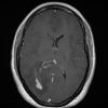 2A3 MS, tumefactive (Case 2) T1 with contrast (PreBx) - Copy