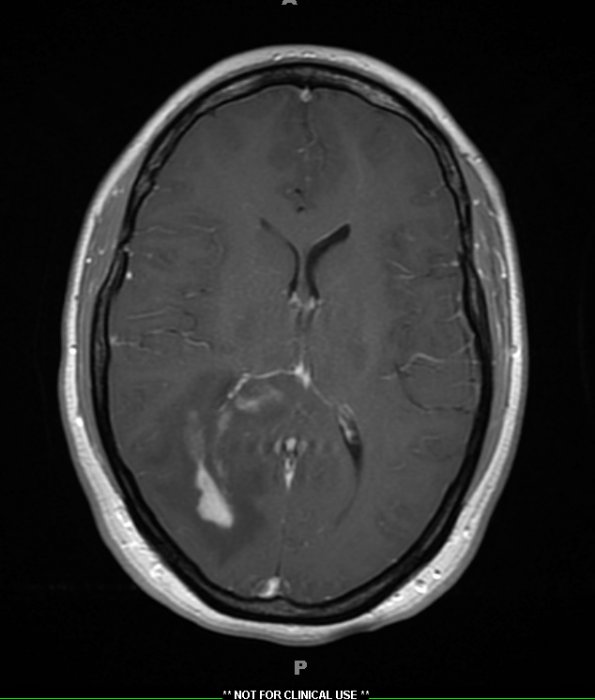 2A3 MS, tumefactive (Case 2) T1 with contrast (PreBx) - Copy