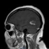 2A4 MS, tumefactive (Case 2) T1 with contrast copy - Copy