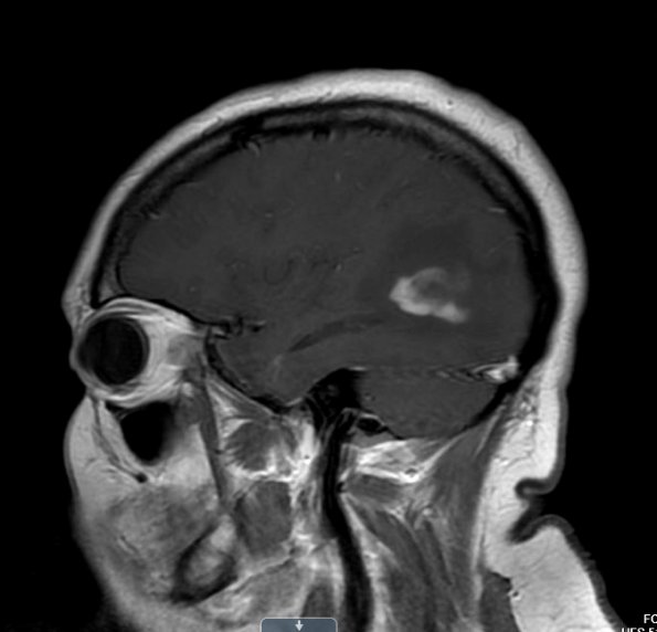 2A4 MS, tumefactive (Case 2) T1 with contrast copy - Copy