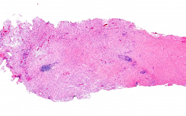 2C1 Tumefactive MS (Case 2) H&E 4X