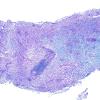 2D1 Tumefactive MS (Case 2) LFB-PAS 4X