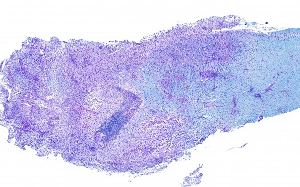 2D1 Tumefactive MS (Case 2) LFB-PAS 4X