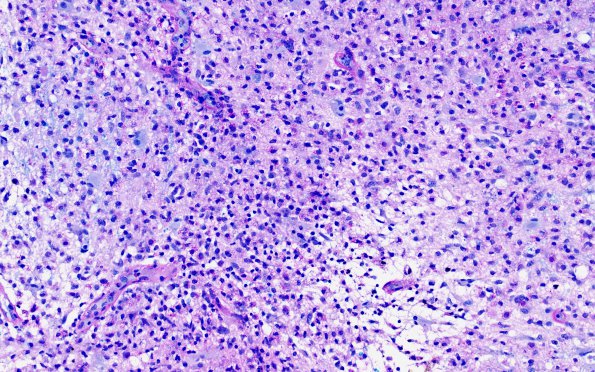 2D2 Tumefactive MS (Case 2) LFB-PAS 20X