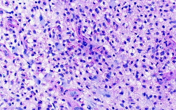 2D3 Tumefactive MS (Case 2) LFB-PAS 40X