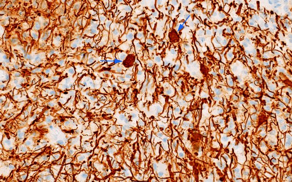 2E3 Tumefactive MS (Case 2) NF 40X copy