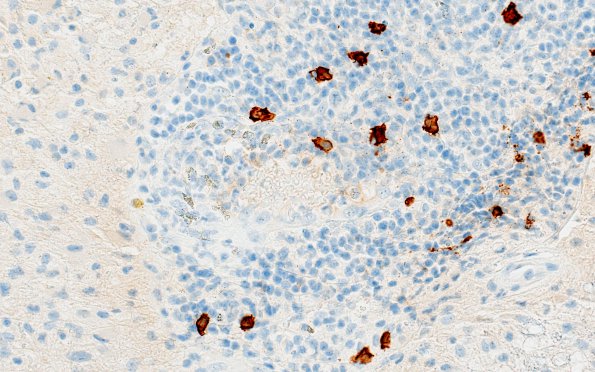 2H3 Tumefactive MS (Case 2) CD20 40X