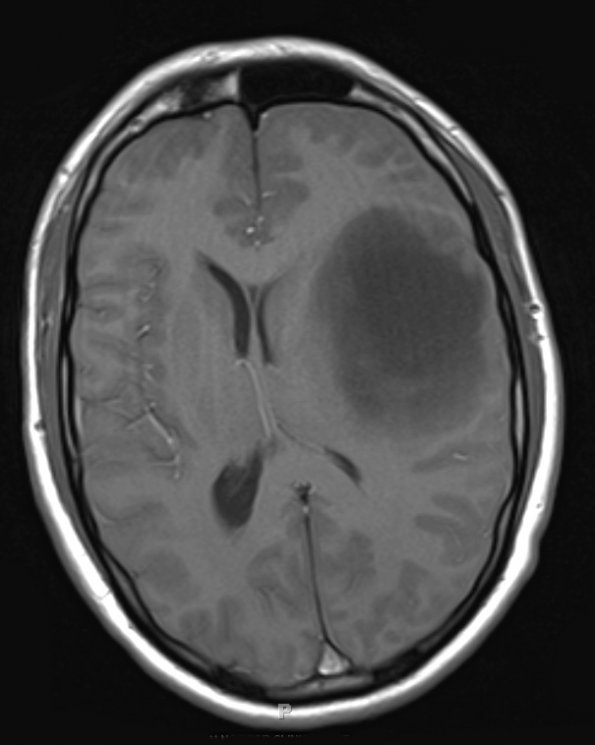 3A1 Tumefactive MS (Case 3) 2nd series T1 without contrast 1 - Copy