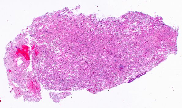 3C1 MS, Tumefactive (Case 3) H&E 2X