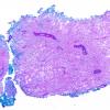 3C3 MS, Tumefactive (Case 3) LFB-PAS 2X