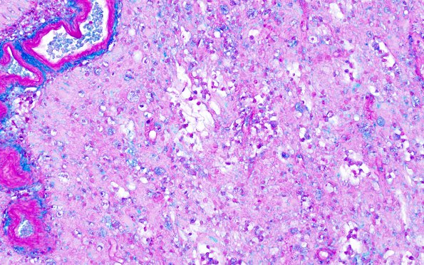 3C4 MS, Tumefactive (Case 3) LFB-PAS 20X