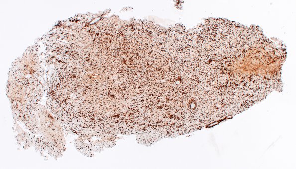 3C7 MS, Tumefactive (Case 3) CD163 2X