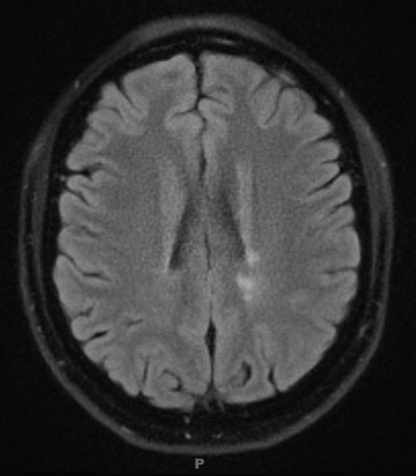 1A2 MS, Secondary Progressive, fulminant (Case 1) 9-2010 T2 FLAIR 3 - Copy