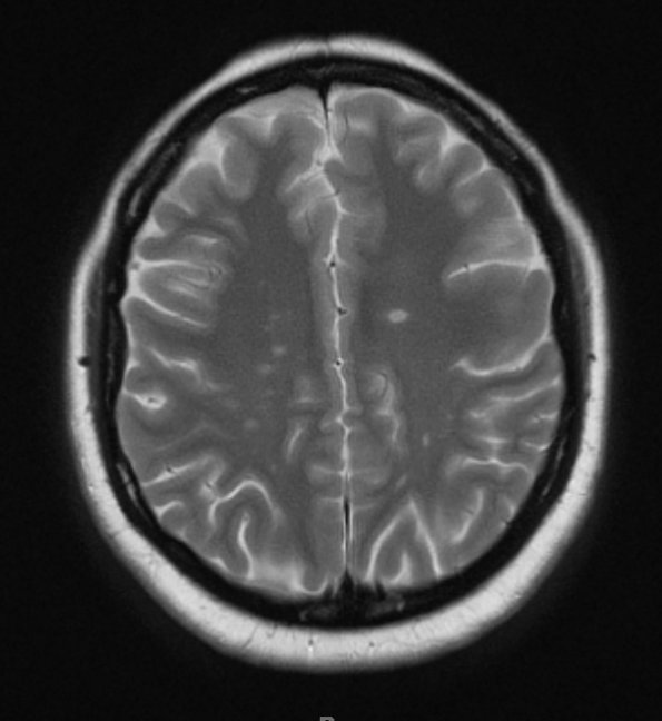 1A3 MS, Secondary Progressive, fulminant (Case 1) 9-2010 T2 with contrast 1 - Copy