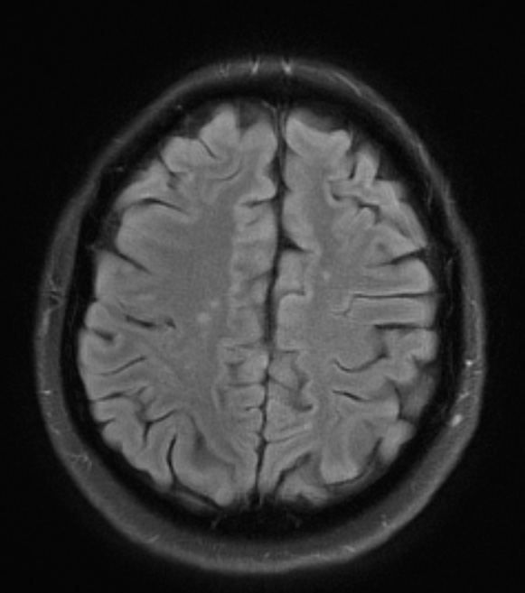 1A5 MS, Secondary Progressive, fulminant (Case 1) 10-2013 FLAIR 2 - Copy