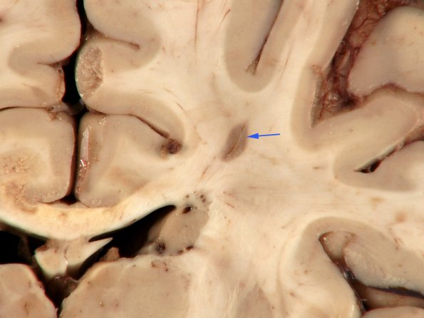 1B1 MS, Secondary Progressive, fulminant (Case 1) 13 copy