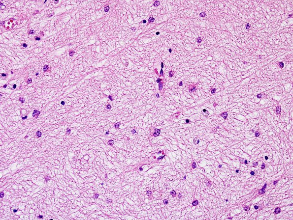 1B10 MS, Secondary Progressive, fulminant (Case 1) Lt Perivent H&E 1