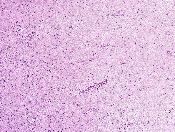 1B6 MS, Secondary Progressive, fulminant (Case 1) Lt Perivent H&E 3