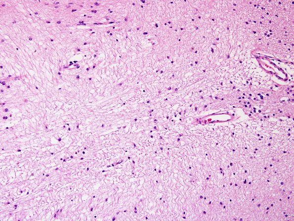 1B7 MS, Secondary Progressive, fulminant (Case 1) LT1 H&E 1