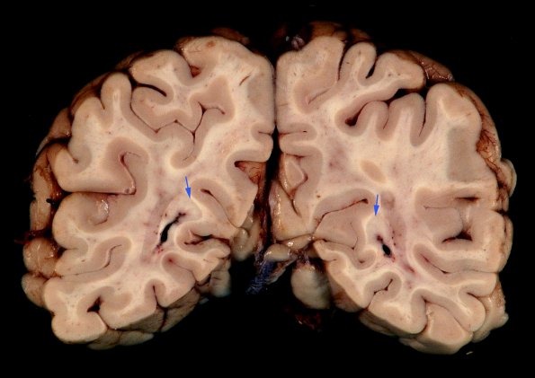 1B8 MS, Secondary Progressive, fulminant (Case 1) 5 copy