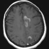 1C2 MS, Secondary Progressive, fulminant (Case 1) 7-2015 T1 with contrast 1 - Copy