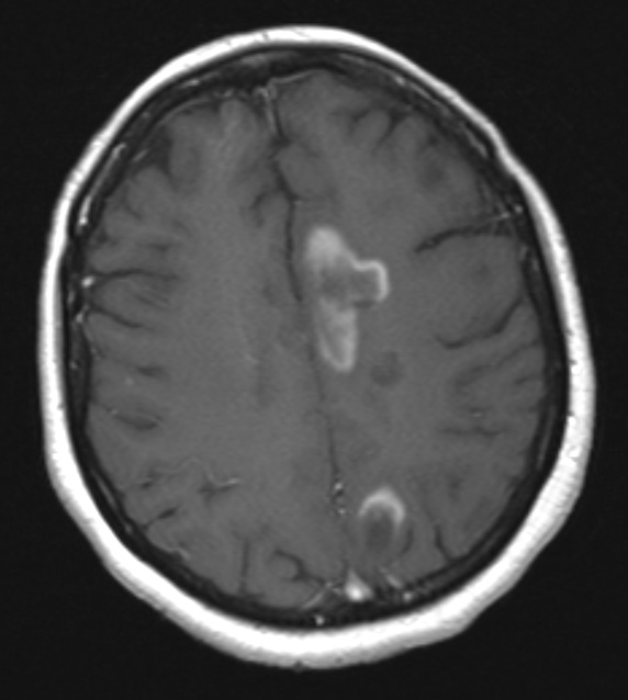 1C2 MS, Secondary Progressive, fulminant (Case 1) 7-2015 T1 with contrast 1 - Copy