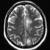 1C3 MS, Secondary Progressive, fulminant (Case 1) 7-2015 T2 1 - Copy