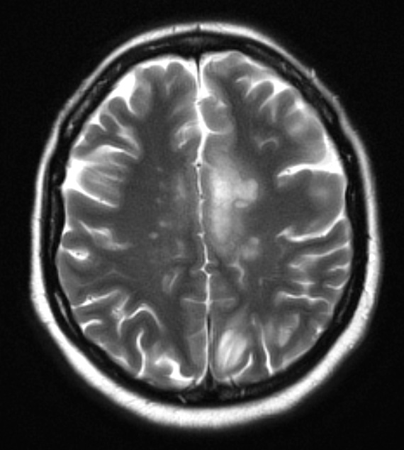 1C3 MS, Secondary Progressive, fulminant (Case 1) 7-2015 T2 1 - Copy