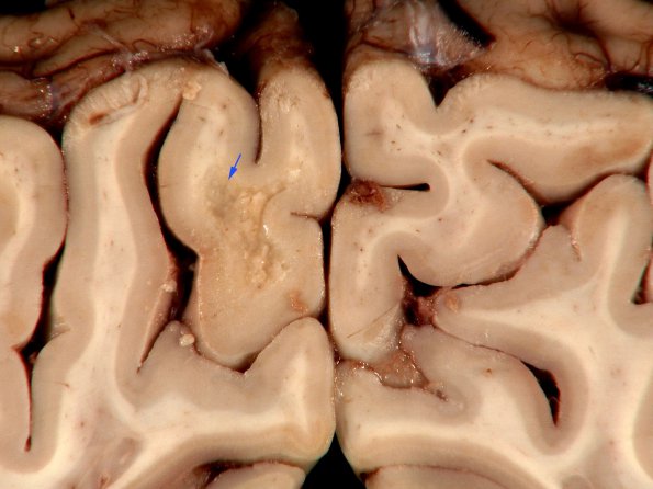 1C4 MS, Secondary Progressive, fulminant (Case 1) 15 copy