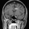 1D1 MS, Secondary Progressive, fulminant (Case 1) 7-2015 T1 with contrast 4 - Copy