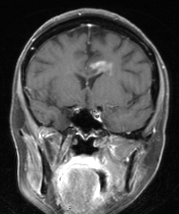 1D1 MS, Secondary Progressive, fulminant (Case 1) 7-2015 T1 with contrast 4 - Copy