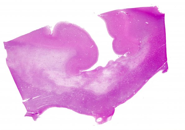 1D3 MS, Secondary Progressive, fulminant (Case 1) CC2 H&E whole mount