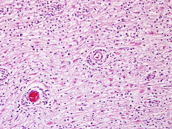 1D4 MS, Secondary Progressive, fulminant (Case 1) CC2 H&E 22