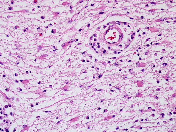 1D5 MS, Secondary Progressive, fulminant (Case 1) CC2 H&E 21 40X