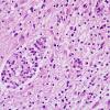 1D6 MS, Secondary Progressive, fulminant (Case 1) CC2 NF Antigen area H&E