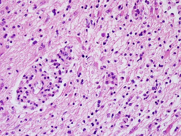 1D6 MS, Secondary Progressive, fulminant (Case 1) CC2 NF Antigen area H&E