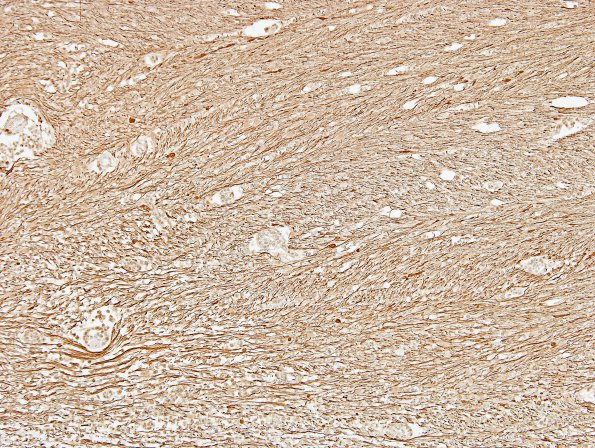 1F2 MS, Secondary Progressive, fulminant (Case 1) CC2 NF 13