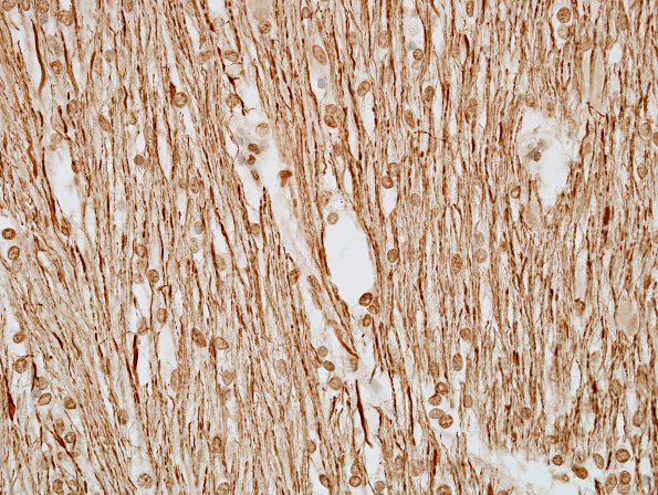 1F3 MS, Secondary Progressive, fulminant (Case 1) CC2 NF 3