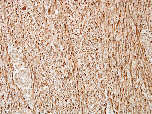 1F4 MS, Secondary Progressive, fulminant (Case 1) CC2 NF 6