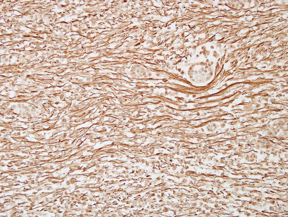 1F5 MS, Secondary Progressive, fulminant (Case 1) CC2 NF 17