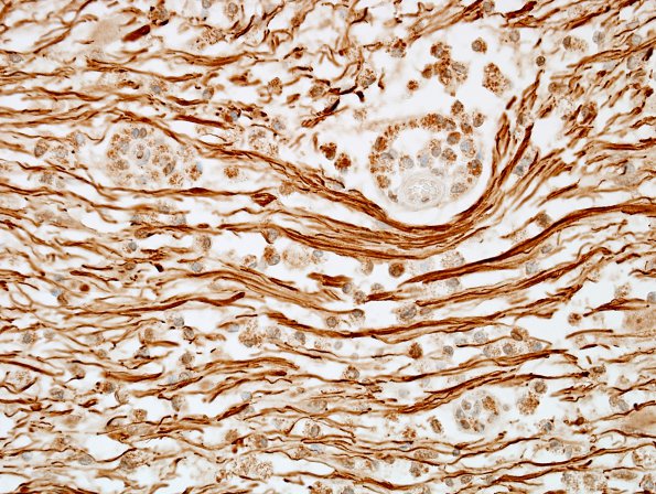 1F6 MS, Secondary Progressive, fulminant (Case 1) CC2 NF 20