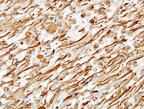 1F7 MS, Secondary Progressive, fulminant (Case 1) CC2 NF Antigen 4 copy